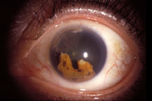 Eye with cataract and damaged iris 