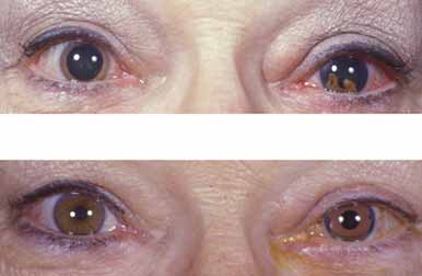 Before and After picture. Right Eye with cataract and damaged iris, left eye normal