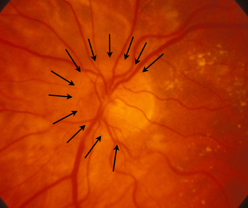 Optic Disc Edema COMS Grading