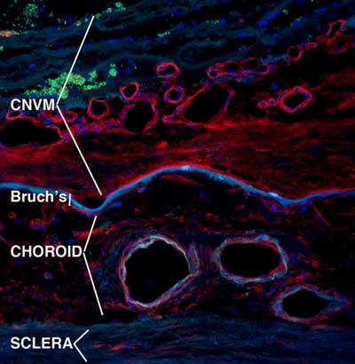 Choroidal neovascularization. See caption for description