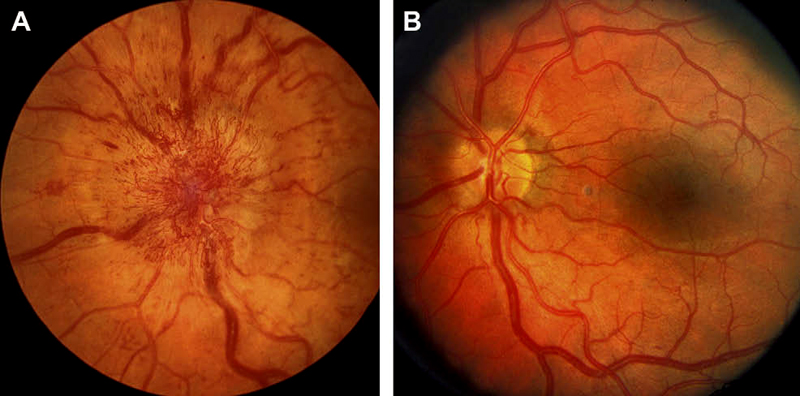 Fundus photographs of left eye of a 53-year-old man