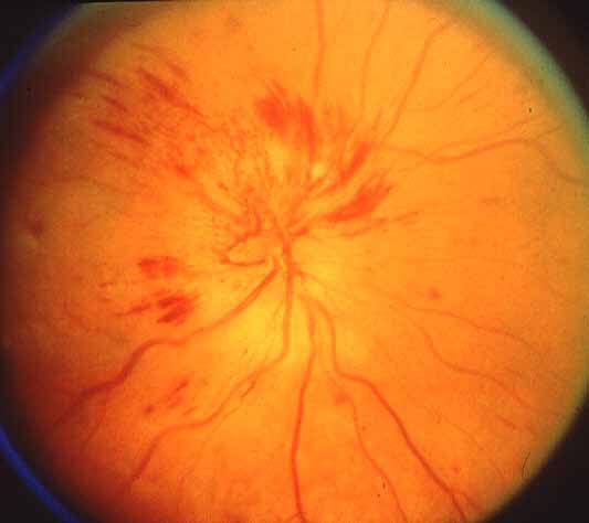 During early stage with optic disc edema with prominent blood vessels on the disc and many retinal hemorrhages