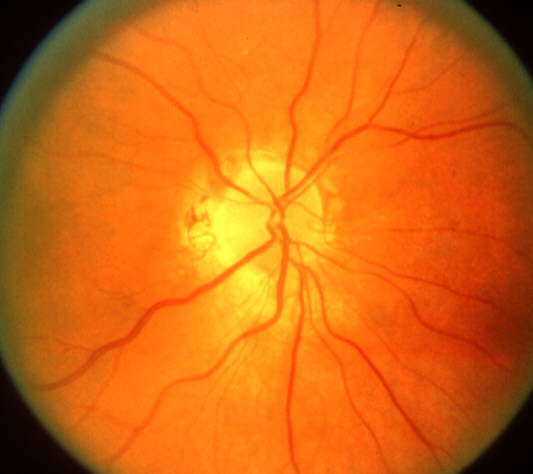 During later stage with pale color (optic atrophy) and spontaneous resolution of prominent blood vessels on the optic disc as well as hemorrhages.