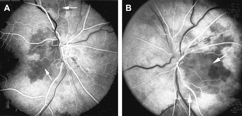 Fluorescein fundus angiogram of 2 eyes with NA-AION showing non-filling of temporal part of the peripapillary choroid (arrow) and adjacent optic disc and the choroidal watershed zone (arrow)