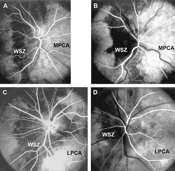 luorescein fundus angiograms of 4 eyes with AION showing different locations of the watershed zone (vertical dark bands) in relation to the optic disc.