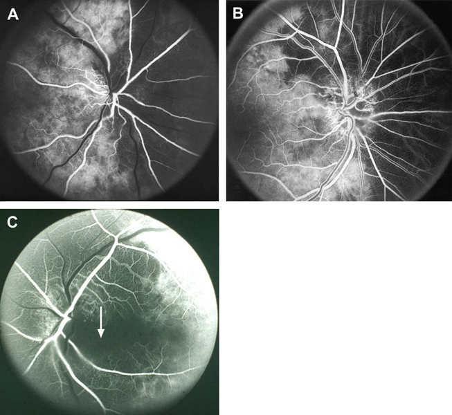 Fluorescein fundus angiograms of 3 eyes showing areas of supply by the occluded posterior ciliary artery and the patent posterior ciliary artery.