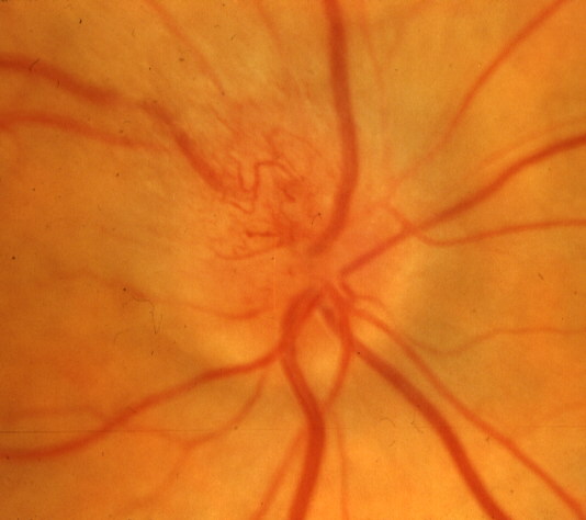 early stages optic disc edema involving the superior temporal part of the optic disc and prominent vessels