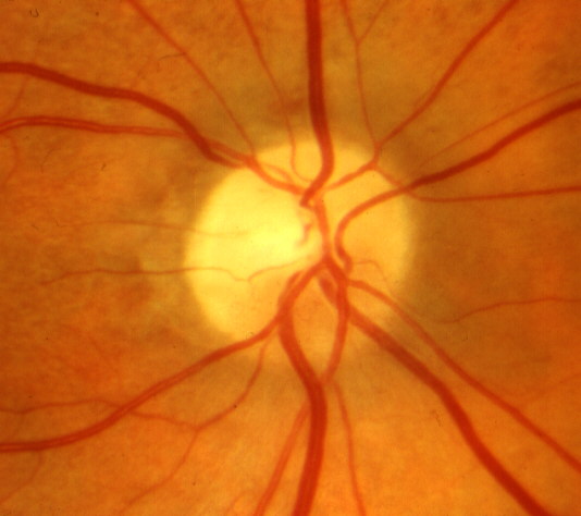 ale color (atrophy) in the upper half of the optic disc – more marked in the temporal than the nasal part, and spontaneous resolution of the prominent blood vessels on the optic disc