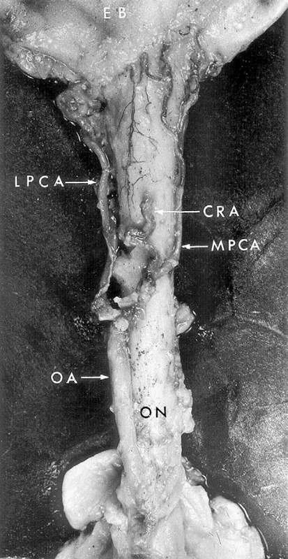 Photograph of inferior surface of the intraorbital part of the optic nerve 