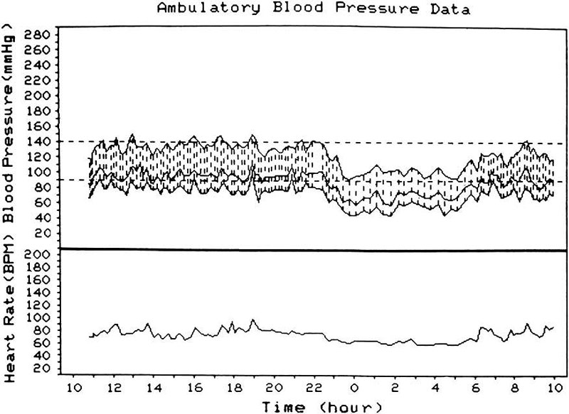 Ambulatory BP and heart rate monitoring records (based on individual readings) over a 24-hour period, starting from about 11 a.m., in a 58-year old woman with bilateral NA-AION, and on no medica­tion. The BP is perfectly normal during the waking hours but there is marked nocturnal arterial hypotension during sleep