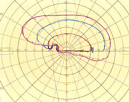 example of fields of vision plotted with a Goldmann Perimeter