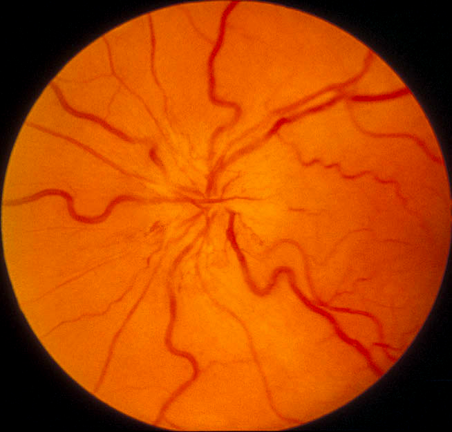 fundus photograph showing optic disc edema and hyperemia during the acute phase of NA-AION