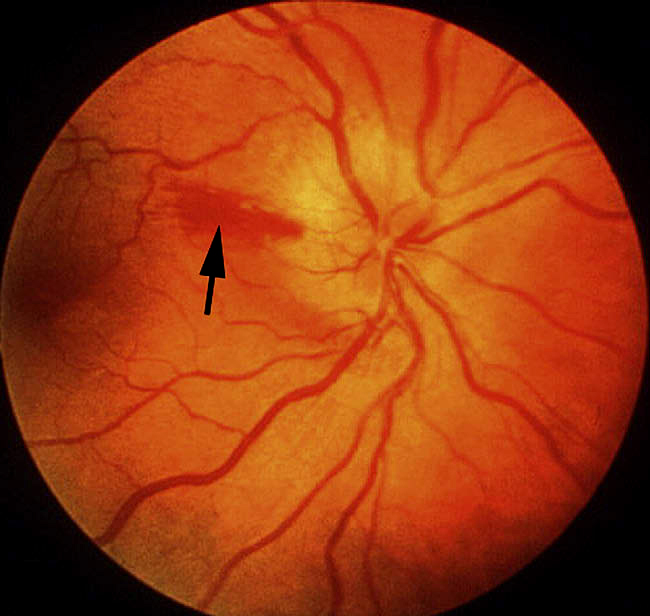 fundus photograph showing optic disc edema and hyperemia, with a splinter hemorrhage 