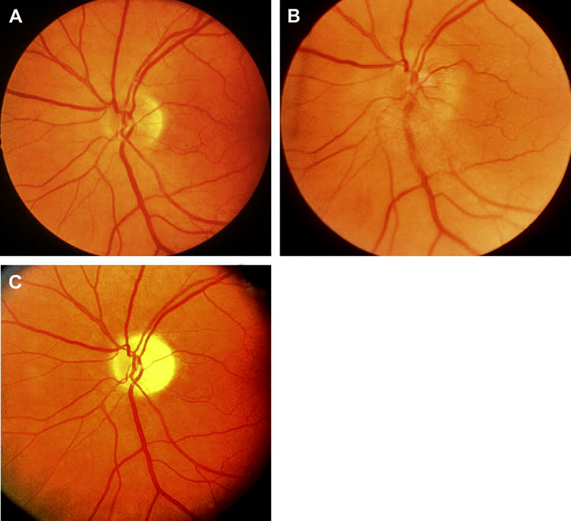 Fundus photographs of left eye of a 53-year-old man. (A) Normal disc before developing NA-AION, (B) with optic disc edema during the active phase of NA-AION, and (C) after resolution of optic disc edema and development of optic disc pallor – more marked in temporal part than nasal part. 