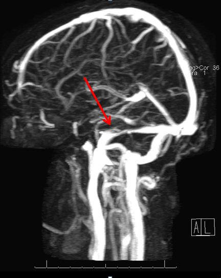 This figure shows is a magnetic resonance venogram showing veins draining the brain. 
The arrow points to a narrow transverse venous sinus likely responsible for pulsatile tinnitus.