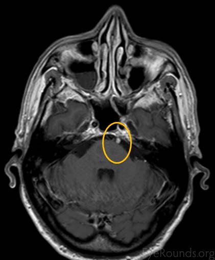 Cranial Nerve 6 Abducens Nerve Palsy Secondary To Schwannoma 4211