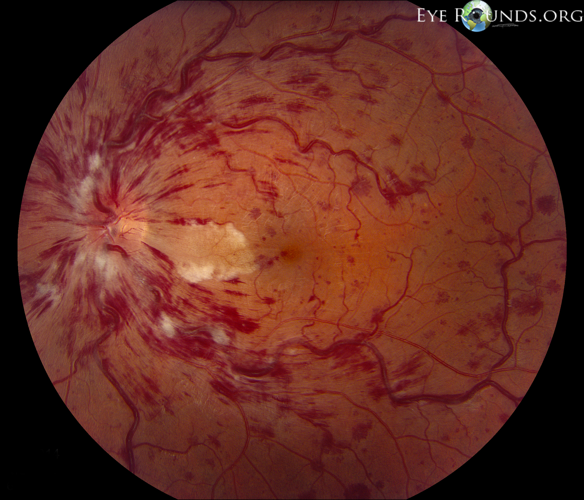 Acute Vision Loss SpringerLink