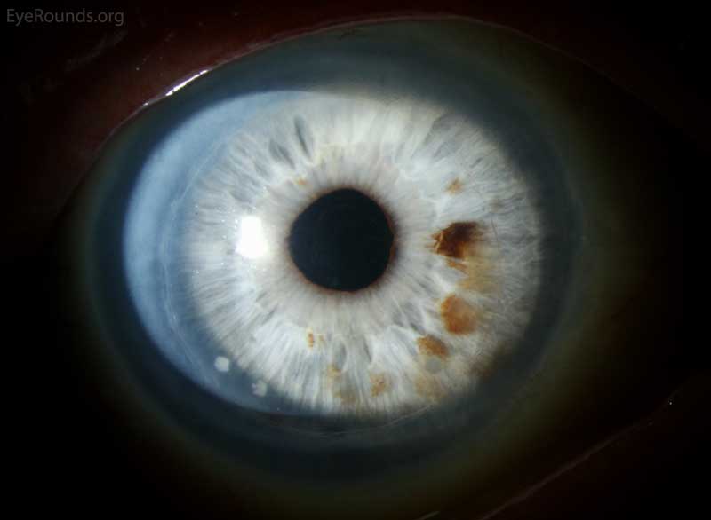 Candida growth within DSAEK interface