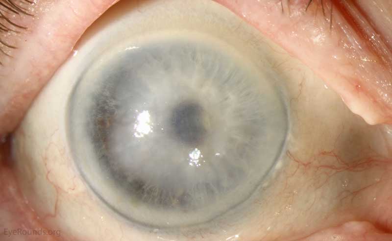 Descemet membrane detachment after cataract extraction