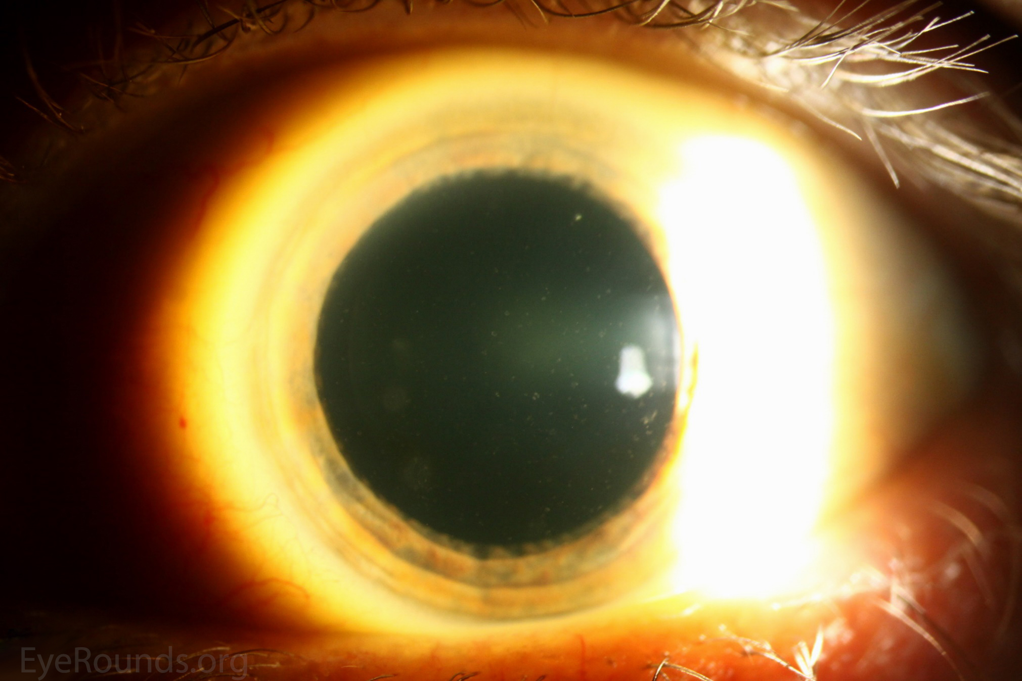 Fleck Corneal Dystrophy (a.k.a. Francois-Neetens speckled corneal dystrophy