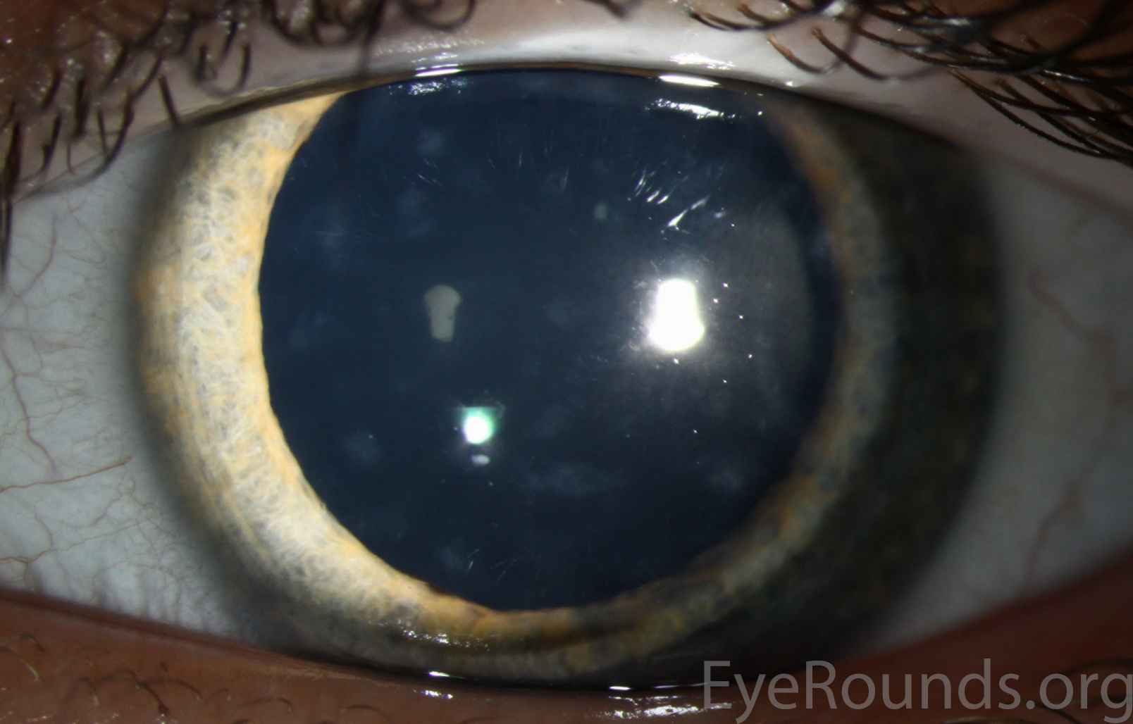 Posterior Polymorphous Corneal Dystrophy (PPMD)