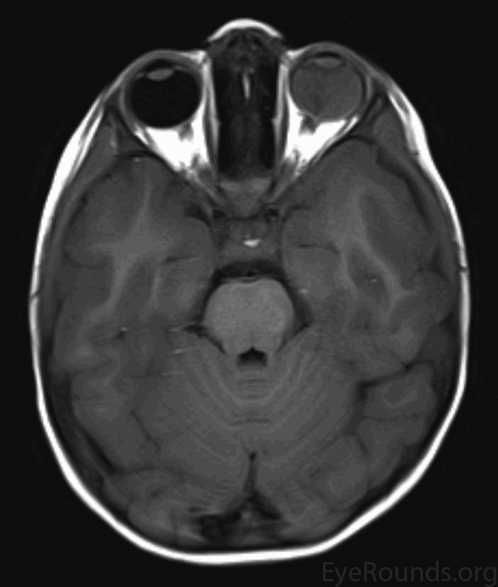 MRI retinoblastoma