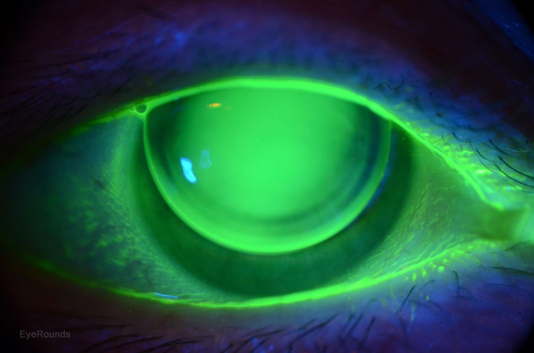Typical Corneal Rigid Gas Permeable (RGP) Contact Lens