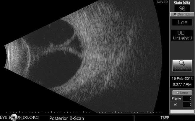 Choroidal Detachment: Serous, Appositional/Kissing