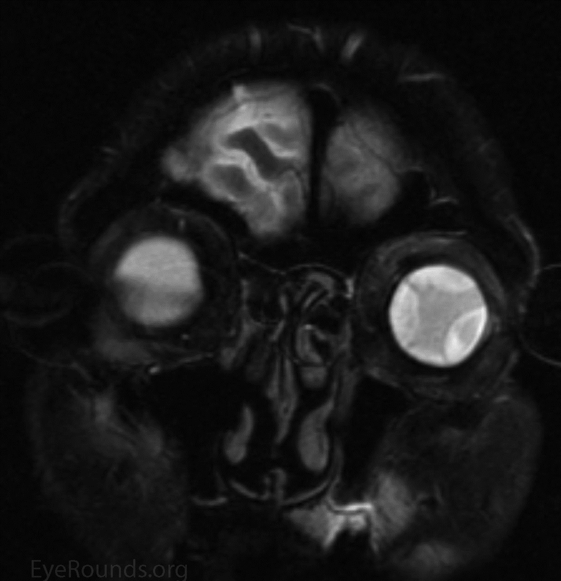 Choroidal Effusion MRI