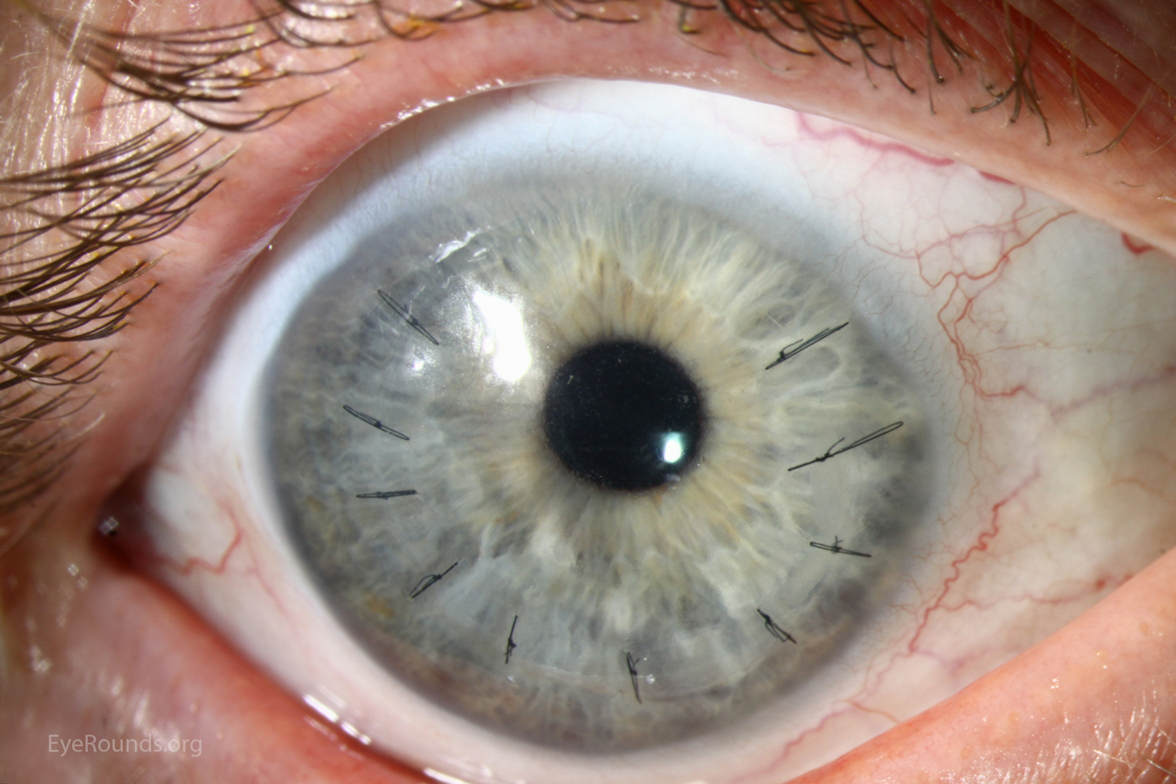 epithelial-ingrowth-under-lasik-flap