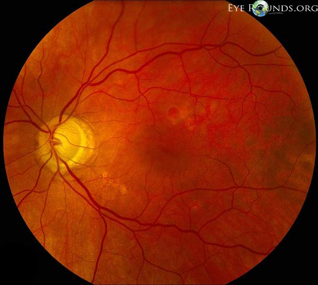 peripapillary atrophy; moderate to advanced optic nerve cupping; normal vessels; pigmentary changes inferotemporal to disc and superotemporal to the fovea center; there is a full-thickness macular hole about 1 disc diameter superior to the fovea center