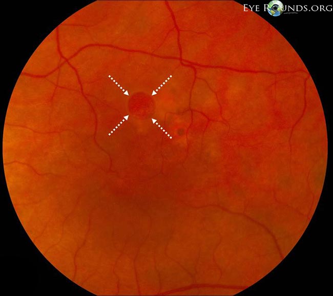 Fundus photograph OS: higher magnification image showing the eccentric/extrafoveal full-thickness macular hole (white arrows)