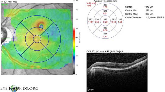OCT OS: scant ERM remnants nasal to the fovea; thinning temporal in areas of prior membrane peeling.