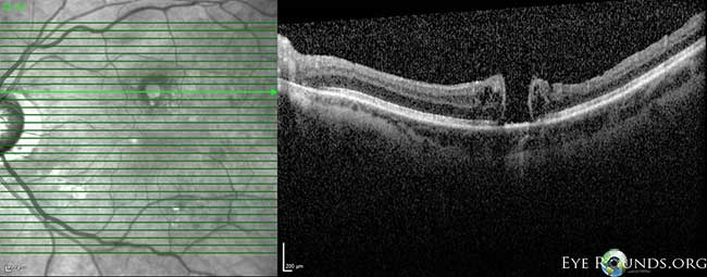 OCT OS: scant ERM remnants nasal to the fovea; thinning temporal in areas of prior membrane peeling.