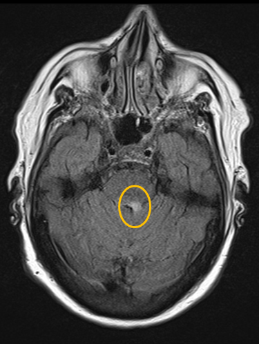 MRI facial colliculus