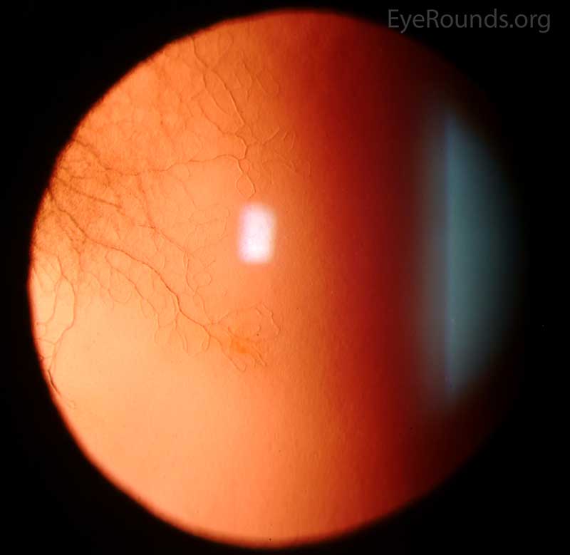 stromal scar in the left eye with regressed blood vessels ("ghost vessels")