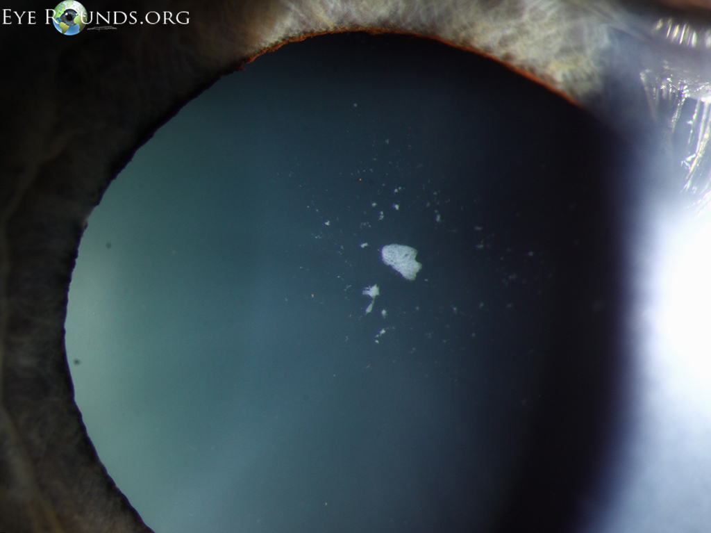 and iris atrophy after acute angle closure glaucoma