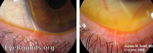 Meibomian Gland Disease Online Ophthalmic Atlas