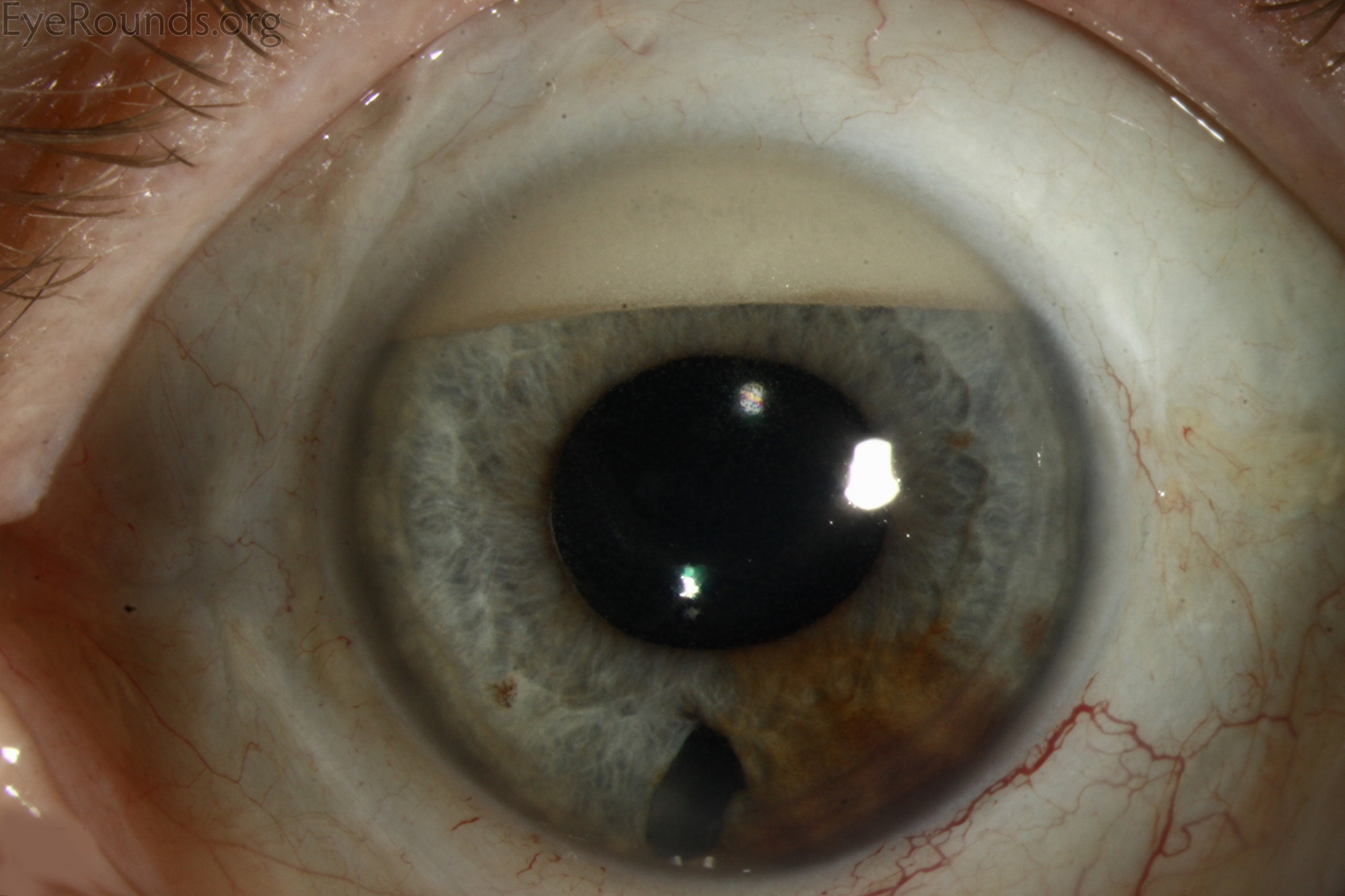 Silicone Oil In Eye 45
