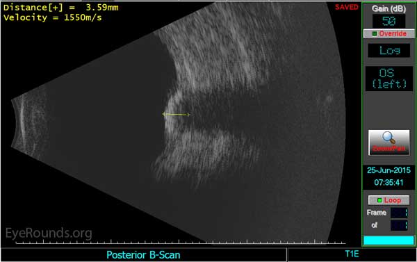 Idiopathic Sclerochoroidal Calcification