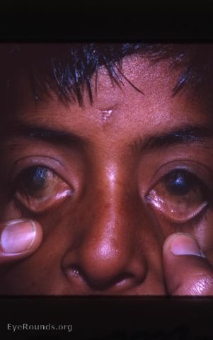 trachoma with xerophthalmia - ? coexistence of trachoma with vitamin A deficiency