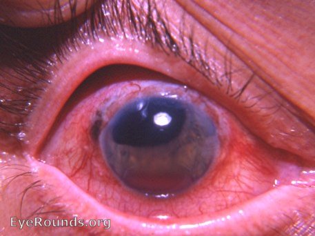 surgically aphakic eye with glaucoma and hyphema