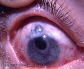 iridencleisis with peripheral iridectomy - a modified iridotasis operation for open- angle glaucoma