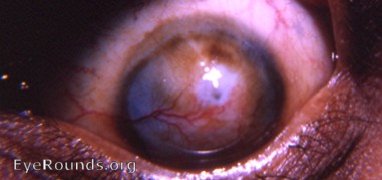 potential descemetocele in vitamin A deficienct with xerophthalmia