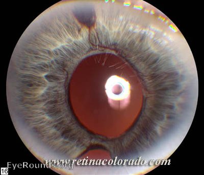 Rubeosis associated with Retinal Detachment
