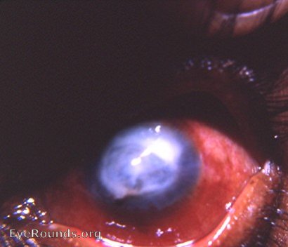 leukomatous cornea with positive Seidel sign with fluorescein solution