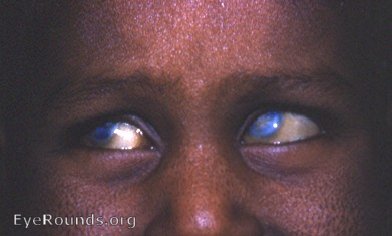 vitamin A deficiency: xerophthalmia with corneal scarring and xeroderma
