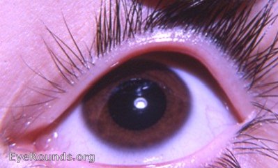 heterochromia brown normal eye syndrome left horner atlas os