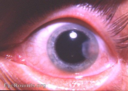 Disciform keratitis due to herpes simplex virus - active stage with neovascularization of cornea.