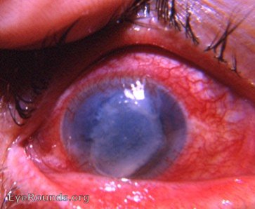 Disciform keratitis due to herpes simplex virus - active stage with neovascularization of cornea.